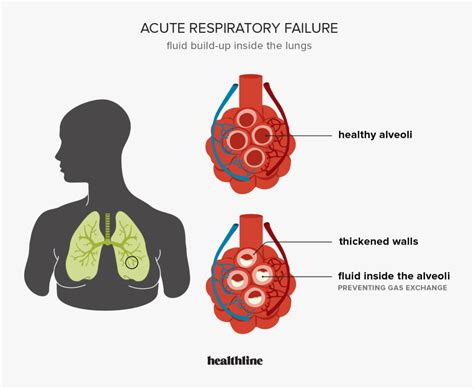 ryan gasacao|Acute respiratory failure in a rapidly.